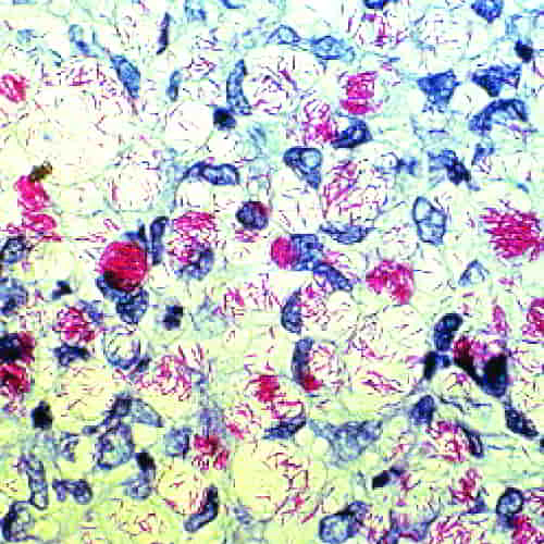 Hansens disease, leprosy Mycobacterium leprae