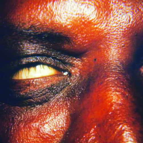 Leprosy can also cause crippling of hands and feet, loss of limbs, tissue loss on the face, and blindness