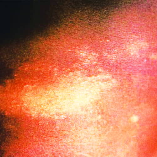 Paucibacillary leprosy is characterized by one or a few hypopigmented skin macules