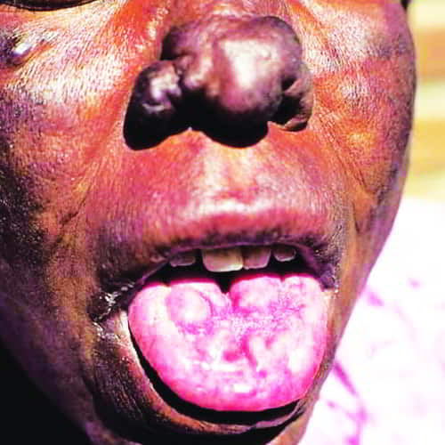 Leprosy patient's tongue