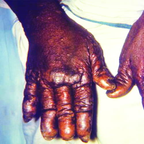 Leprosy patient's hand